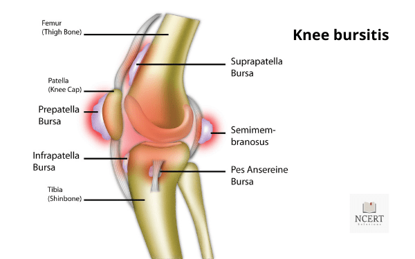 घुटने का बर्साईट के कारण घुटनों में दर्द | Knee pain in Hindi | Ghutne me dard