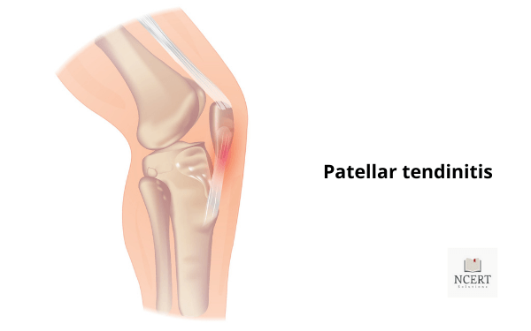 पेटेलर टेडोनाइटिस | Knee pain in Hindi | Ghutne me dard