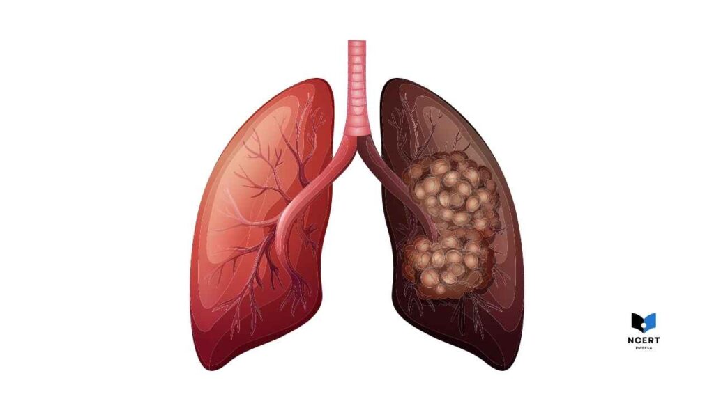 Infection in lungs | Lung cancer early symptoms