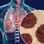Lung cancer symptoms, causes and Treatment