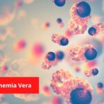Polycythemia Vera Treatment, Symptoms, and diagnosis