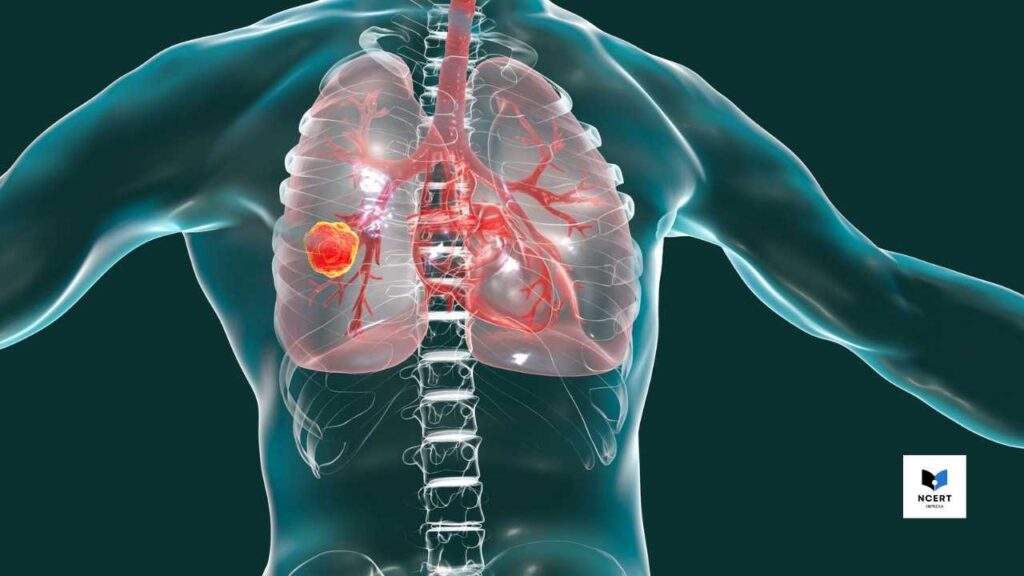 What is Lung cancer? Affected area